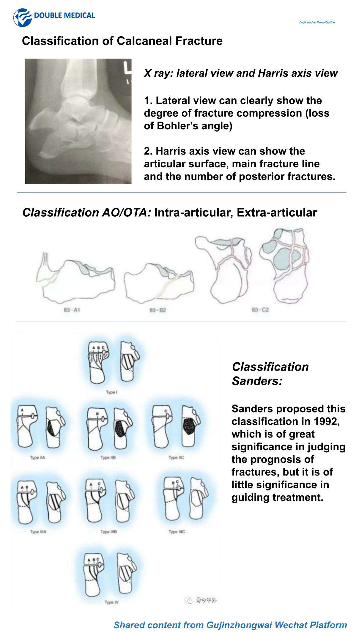  Classification of Calcaneal Fracture