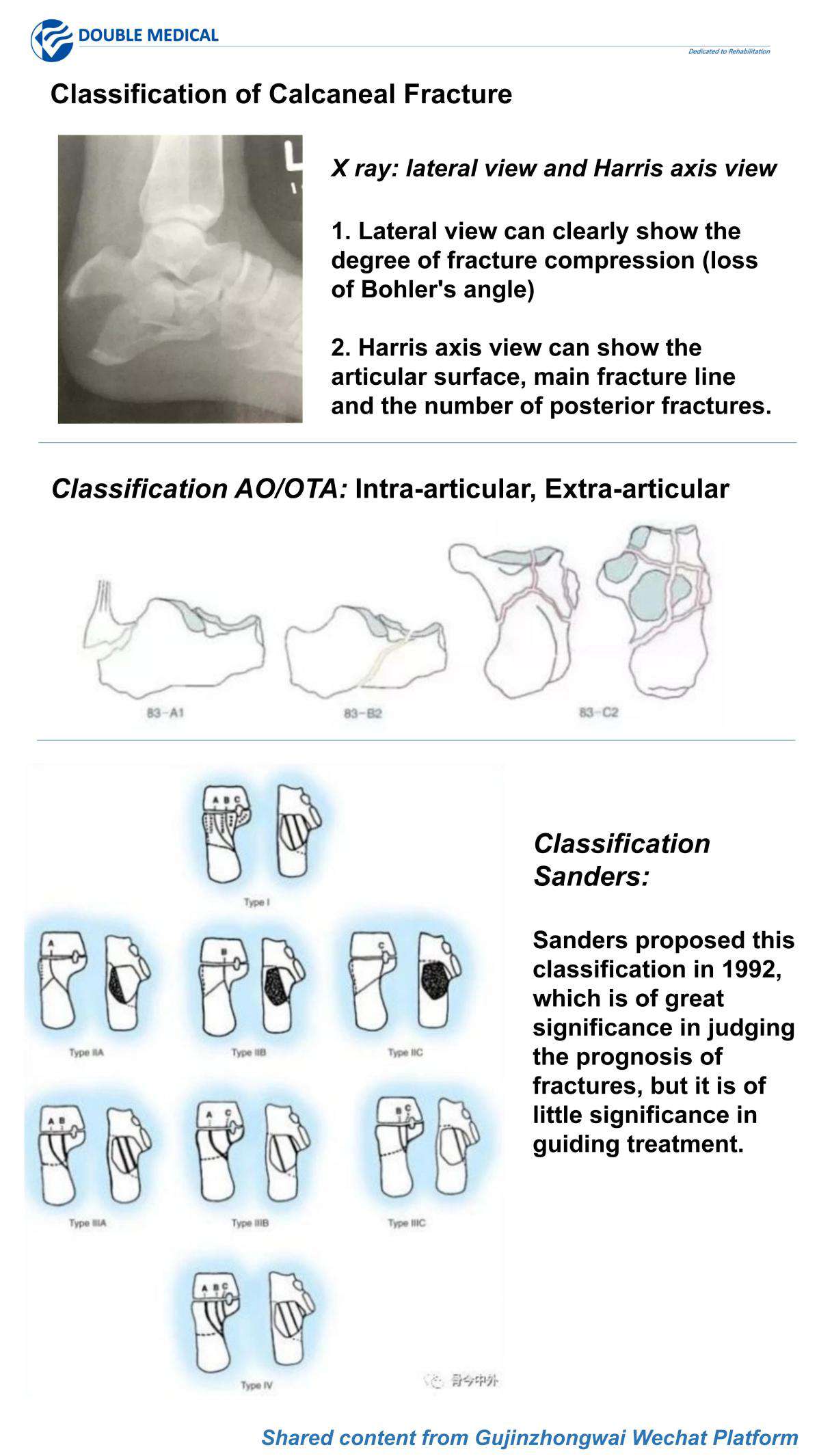  Classification of Calcaneal Fracture