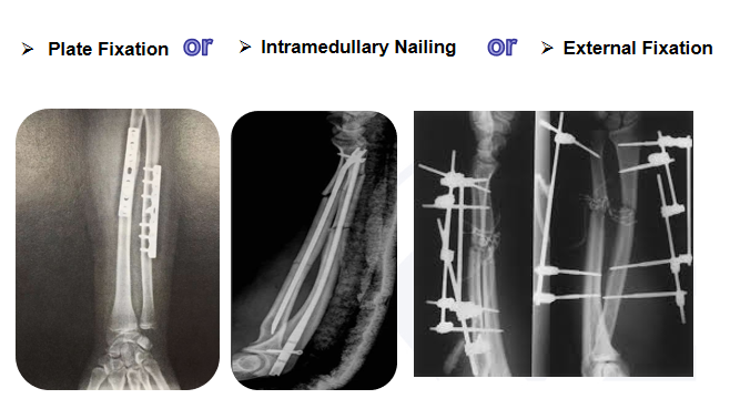 News - Intramedullary Treatment of Intertrochanteric Fracture of Femur – 8  Aspects to Optimize Intramedullary Nail Fixation