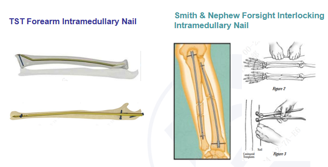 1. Brooker-Wills Interlocking Intramedullary Nail Design: A Comprehensive Review - wide 6