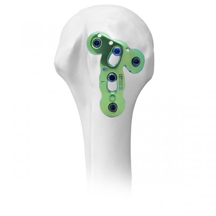 PHL 2 - Proximal Humeral Locking Plate 2 LCP