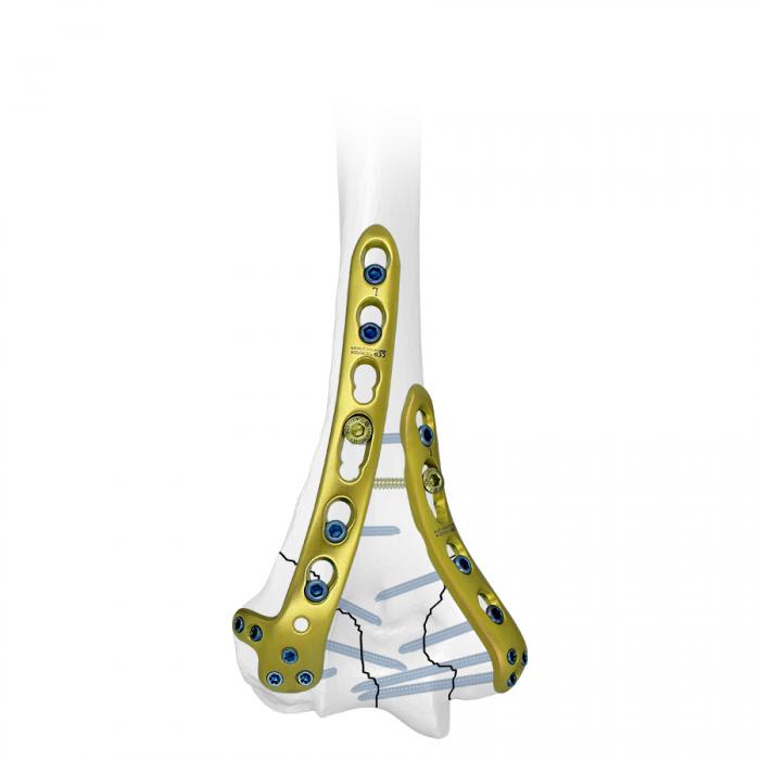 LCP Extra-articular Distal Humerus Plate