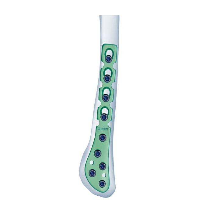 Distal Fibular Compression Plate