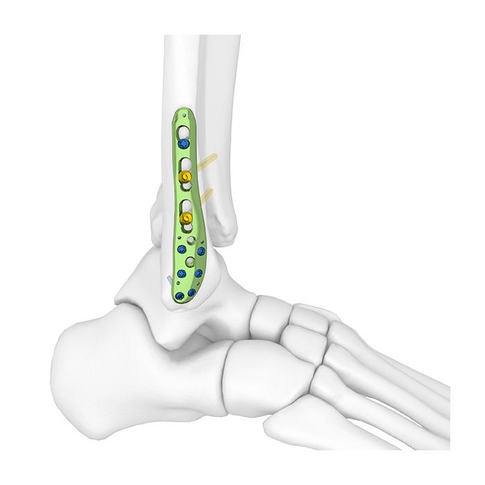 Distal Fibular Locking Plate