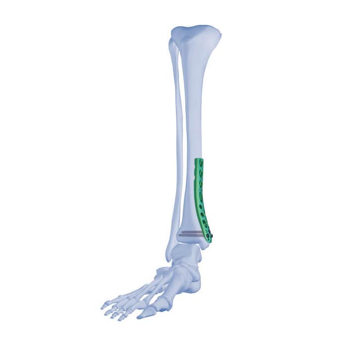 AxSOS 3 Ti Distal Tibia Plating System