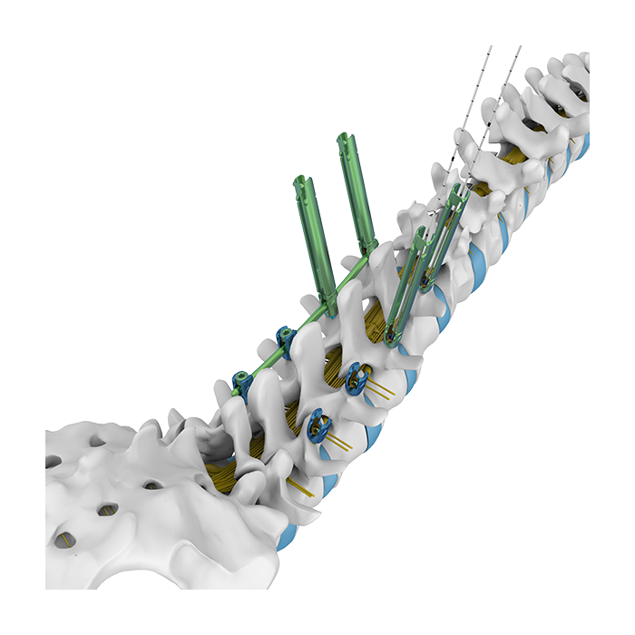 Minimally Invasive Pedicle Screw System