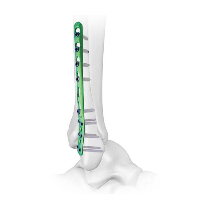 Fibular Compression Plate