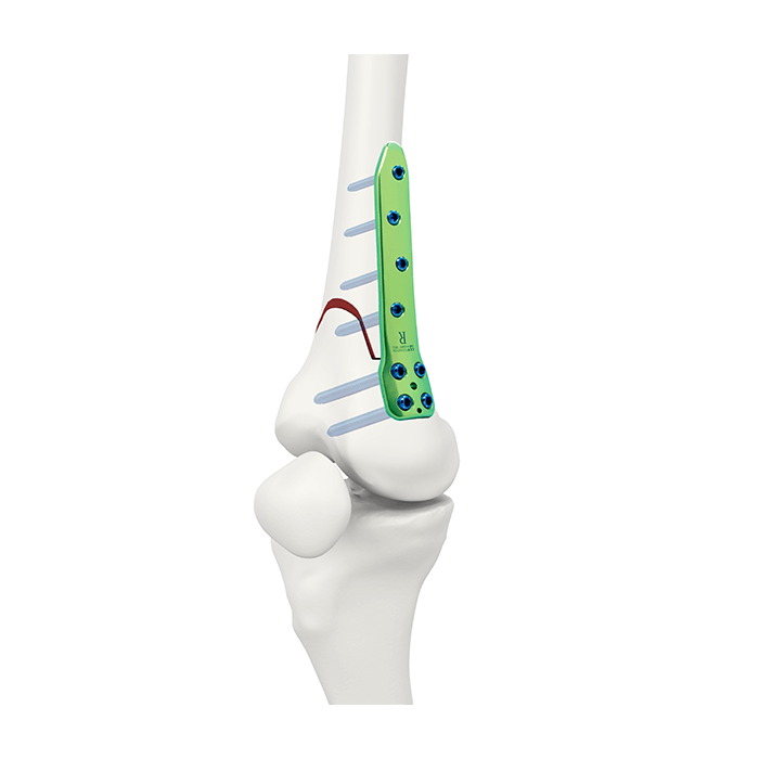 TomoFix® Lateral Distal Femur Plate