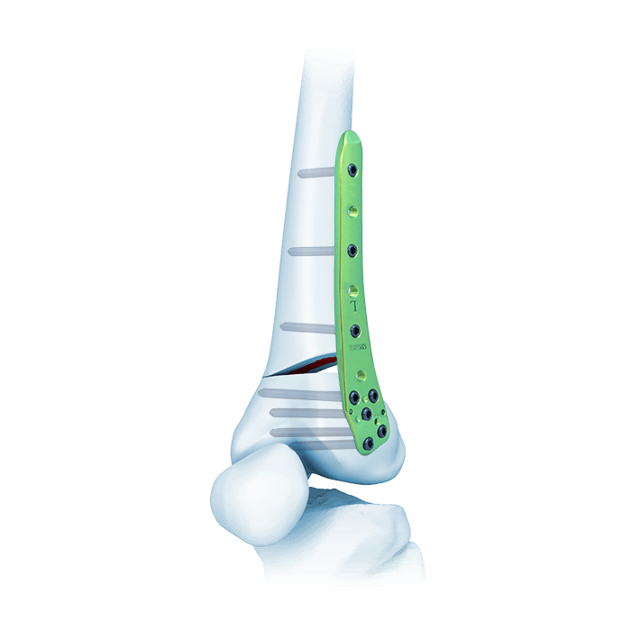 TomoFix® Lateral Distal Femur Plate