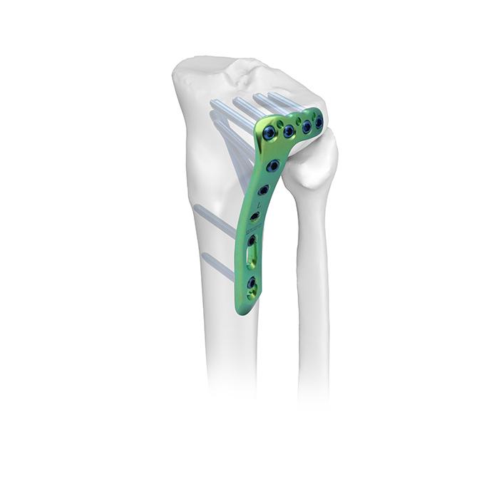 AxSOS 3 Ti Proximal Tibia Plating System