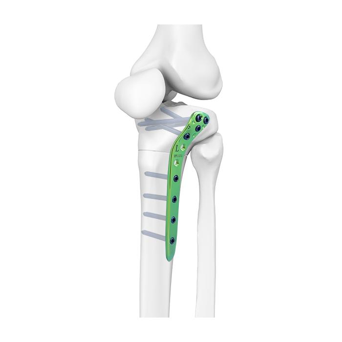 Proximal Lateral Tibia Plate Synthes