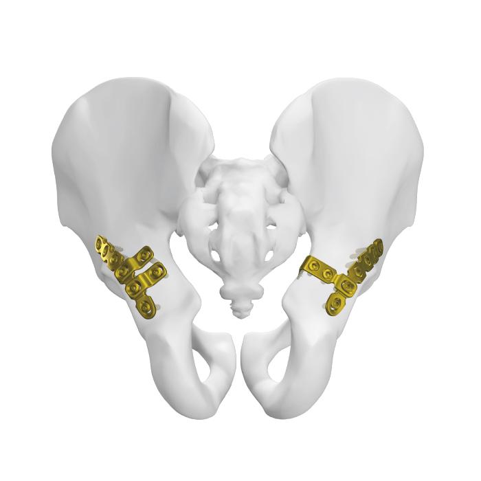 Posterior Pelvic Plate