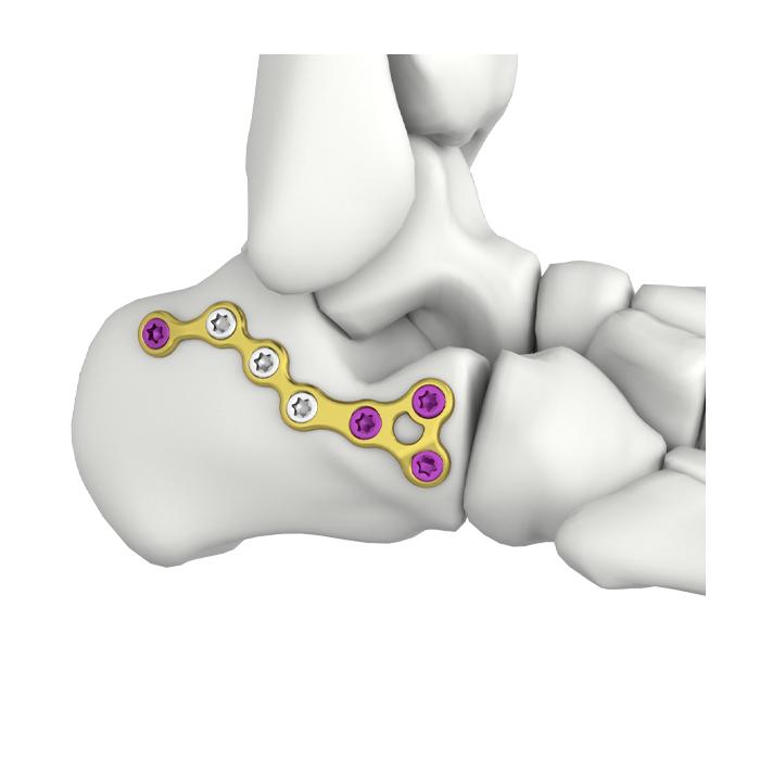 VA Anterior Process Calcaneal Locking Plate