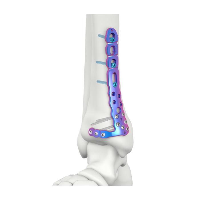 VAL Distal Medial Tibial Locking Plate