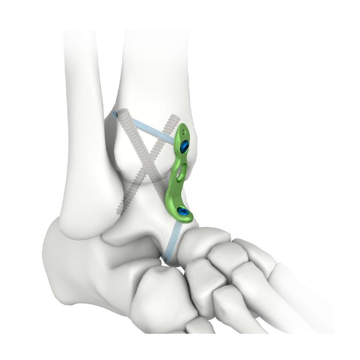 MIS Ankle Fusion Locking Plate