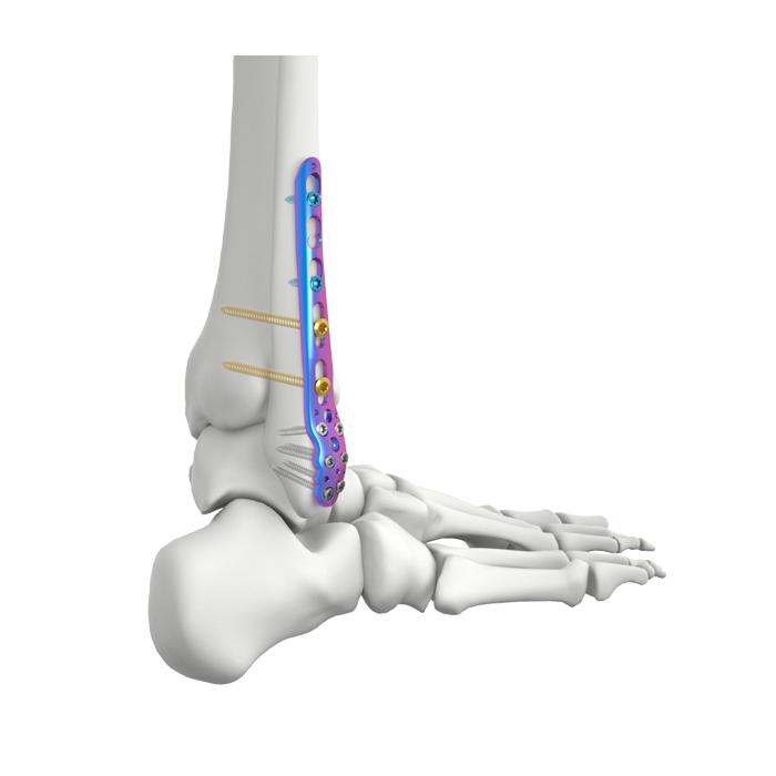 VAL Distal Lateral Fibular Locking Plate