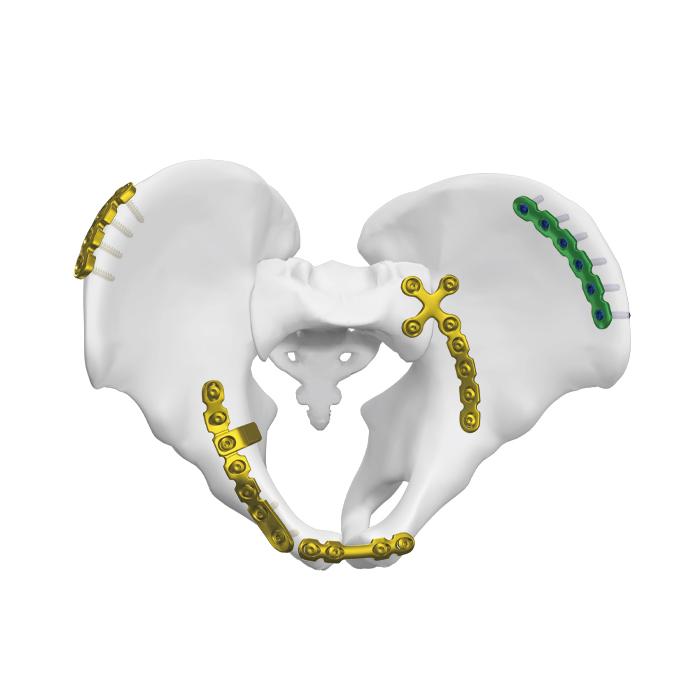 Anterior Sacroiliac Joint Plate