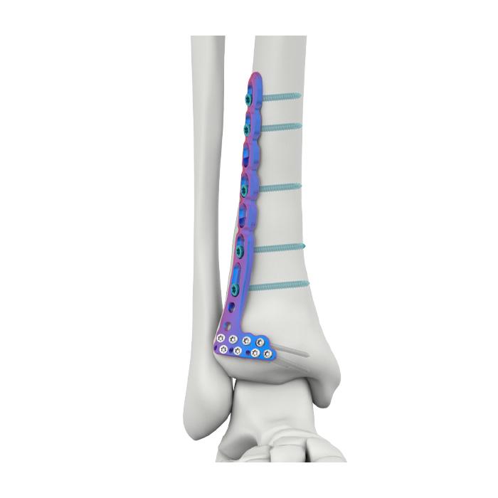 VAL Distal Anterior Lateral Tibial Locking Plate