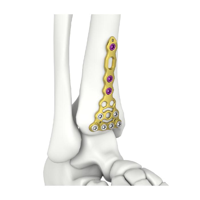 VA Distal Anterior Tibial Locking Plate