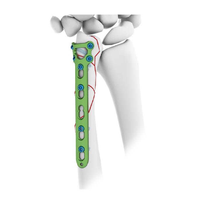 Distal Ulnar Locking Plate