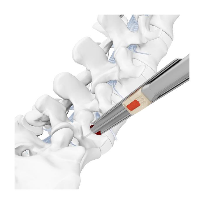 Endo LIF Endoscopic Transforaminal Cage