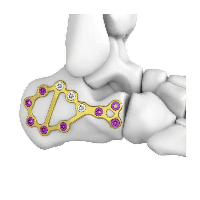 VA Calcaneal Locking Plate