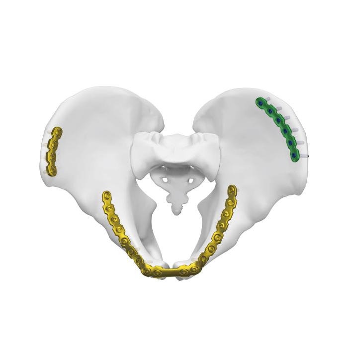 Anatomical Iliopubic Plate