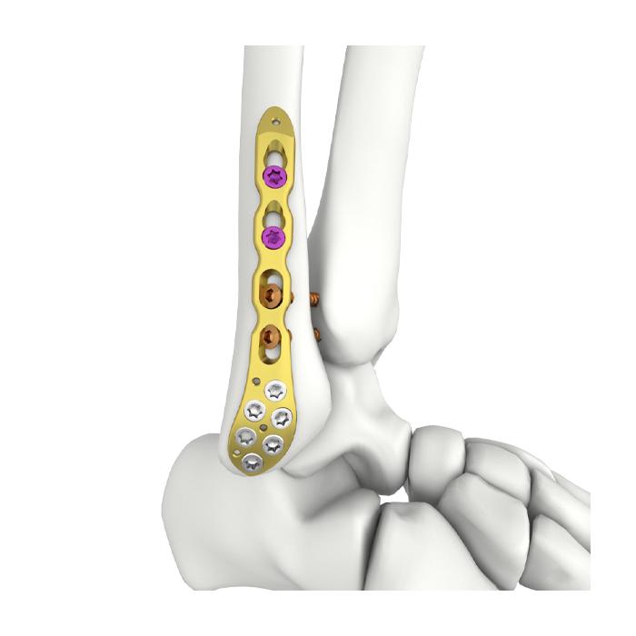 VA Distal Lateral Fibular Locking Plate