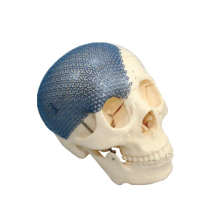Cranial Titanium mesh