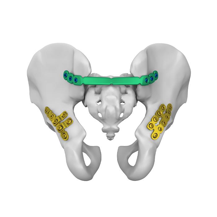 Sacroiliac Joint Plate Ⅱ