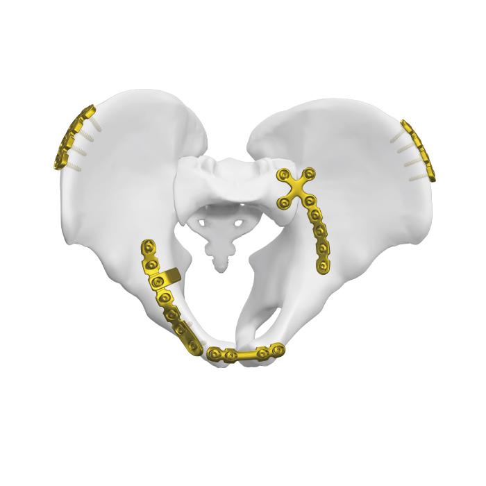 Posterior Surface Quadrangular Plate