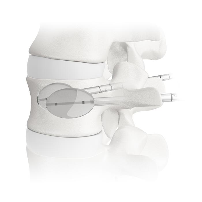 balloon kyphoplasty system