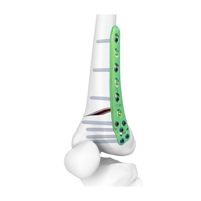 TomoFix® Lateral Distal Femur Plate