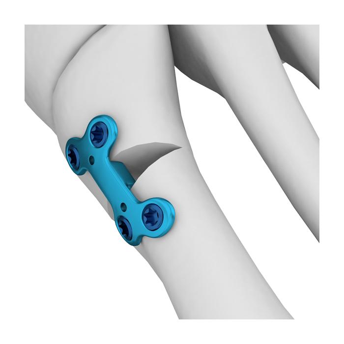 Mini Locking Plate Ankle Foot Locking Cortex Screw First Metatarsal Locking Plate Osteotomy Plate