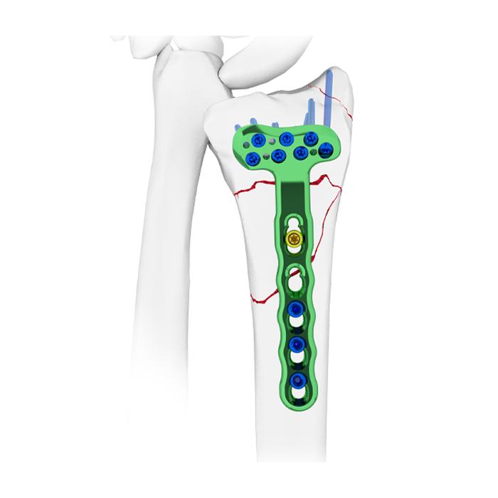 Volar Rim Distal Radius System ExtremiLOCK Wrist Plating System Acu-Loc 2 Volar Distal Radius Plating System Zimmer Distal Radius Plating System PERI-LOC Locked Plating System