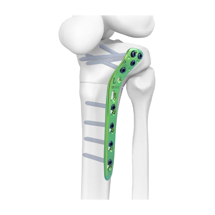 Proximal Lateral Tibia Plate Synthes