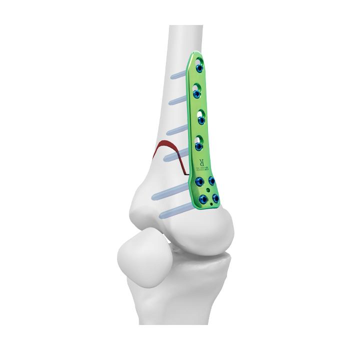 TomoFix® Lateral Distal Femur Plate