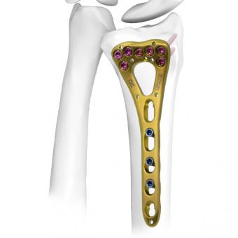 Distal Radius Locking Plate Ⅰ,Variable Angle,Medical Device