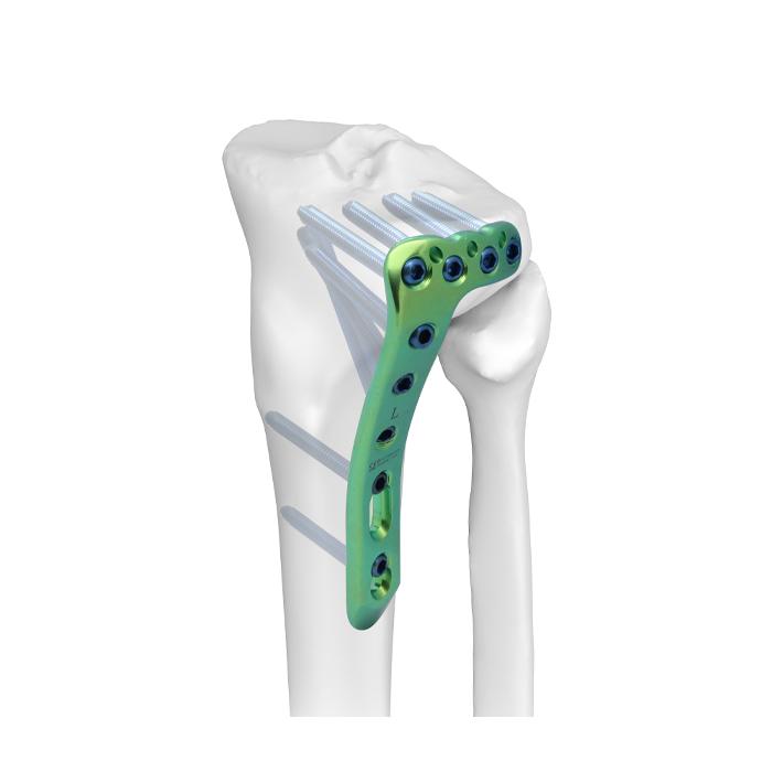 AxSOS 3 Ti Proximal Tibia Plating System