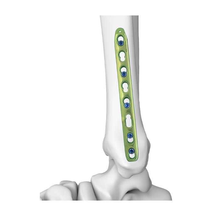 LCP Metaphyseal Plates