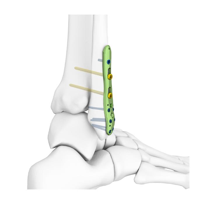 Distal Fibular Locking Plate