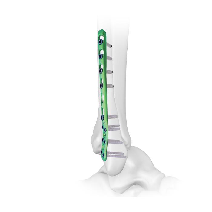 Fibular Compression Plate