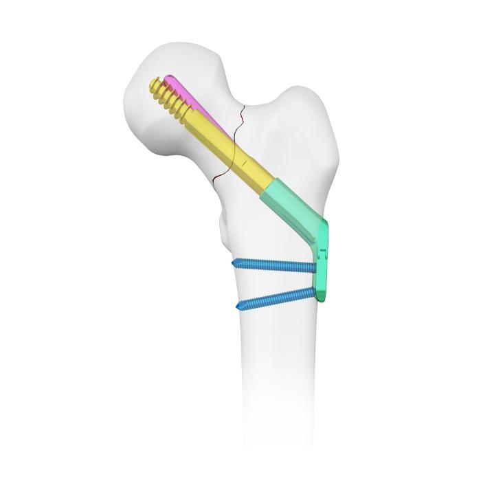 depuy synthes FNS