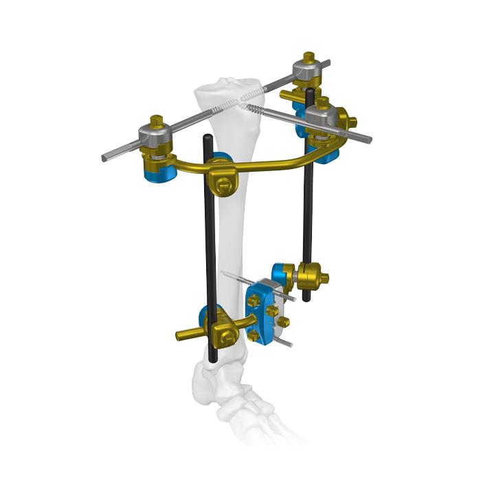 Computer-Assisted Circular External Fixator System