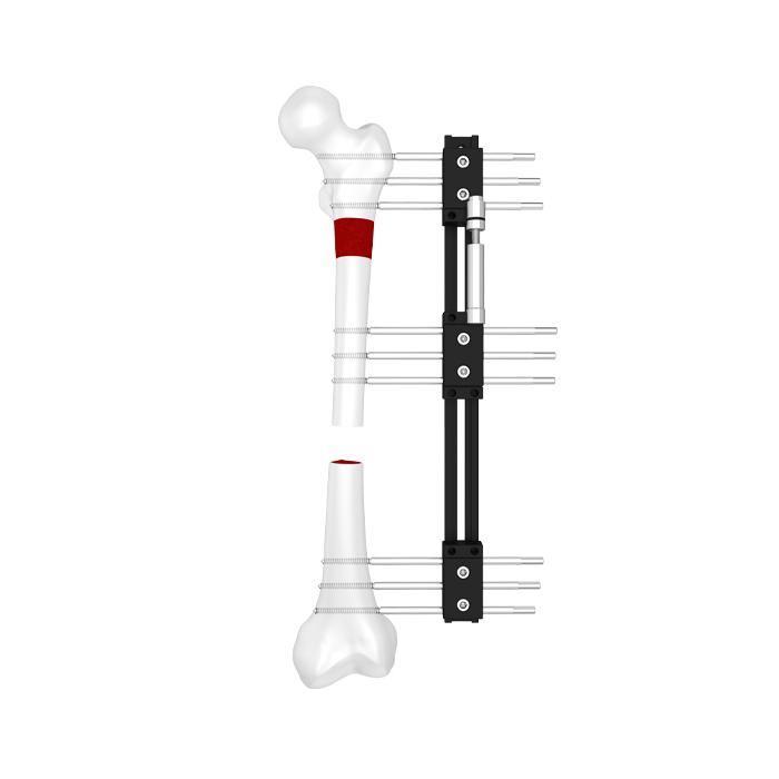 Limb reconstruction and lengthening system