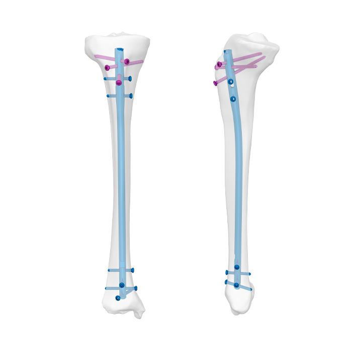 Expert Tibia Nail - Depuy Synthes - PDF Catalogs | Technical Documentation