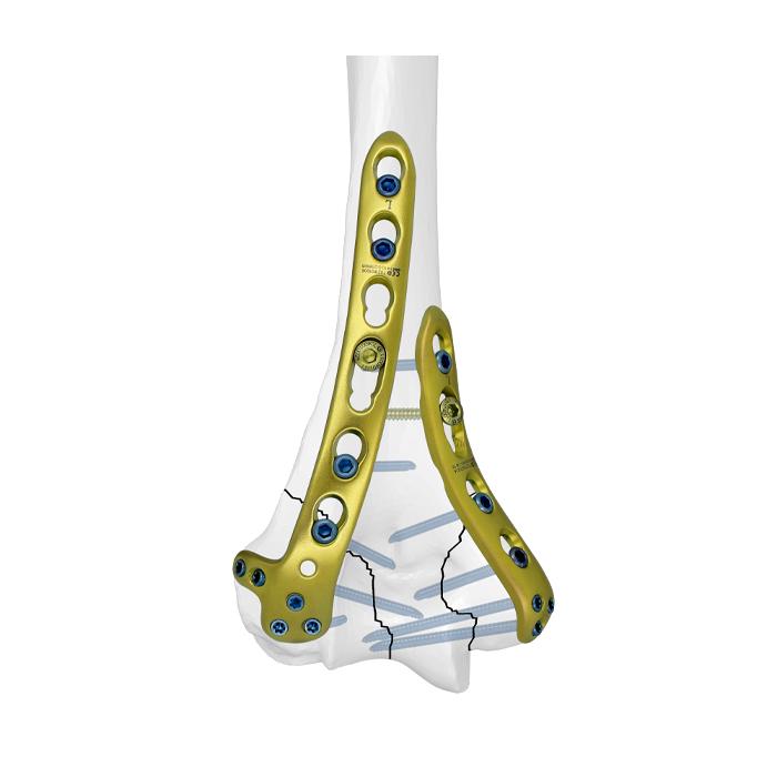 LCP Extra-articular Distal Humerus Plate