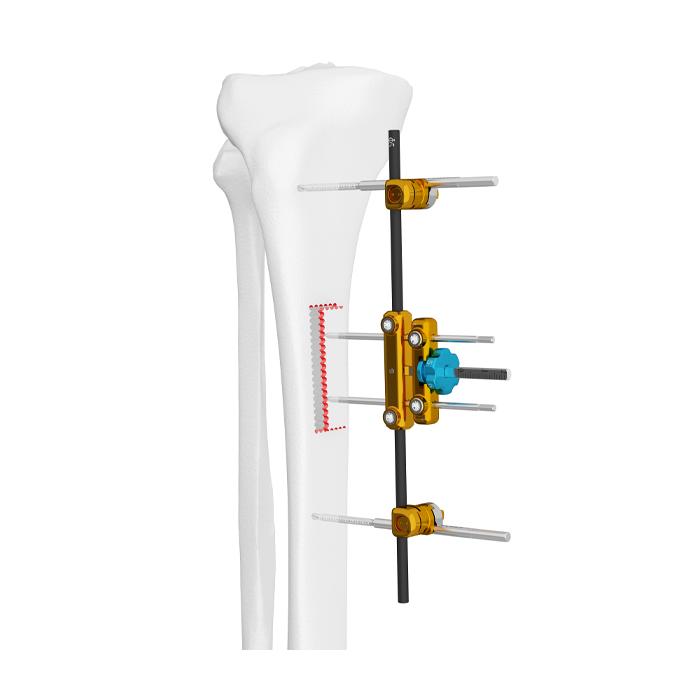 Horizontal transport external fixator