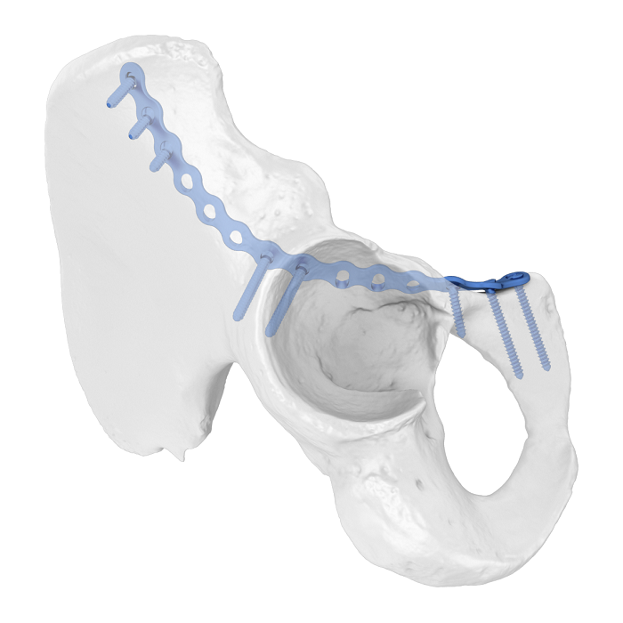 Flexible Acetabular Plate (FAP) System Iliopubic Anterior Column Anatomic Locking Plate