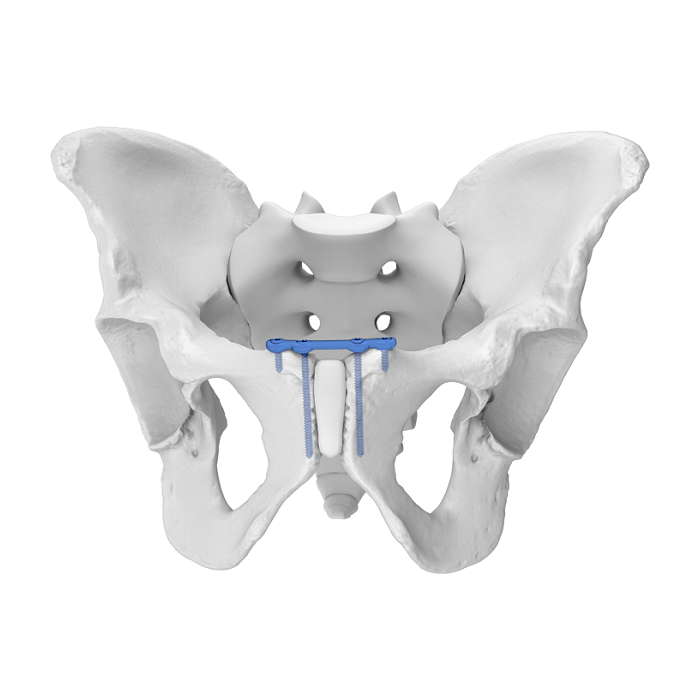 Flexible Acetabular Plate (FAP) System Symphysis Pubis Superior Anatomic Locking Plate